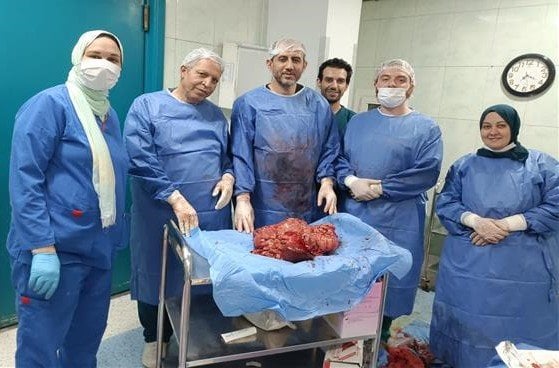 فريق طبي مصري ينجح في استئصال ورم يزن 15 كجم من معدة مريض